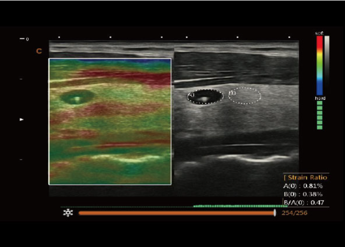 Elastography is possible with this ultrasound system